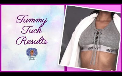 My Tummy Tuck Results | Abdominoplasty