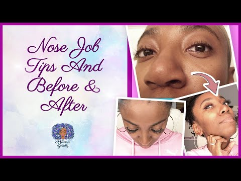 Nose Job For Black Women | Nose Job Before And After Photo