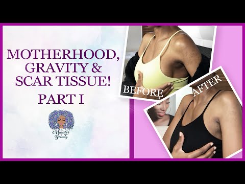 Breast Lift, Augment & Implant Illness | My Issues & Capsular Contraction | Storytime Part II